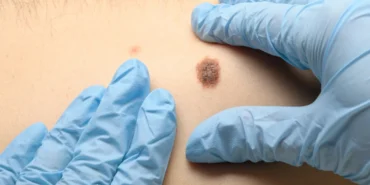 melanoma