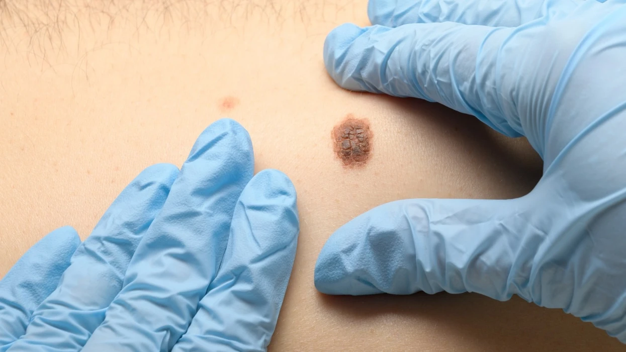 dermatologet-ne-maqedoni-zbulojne-raste-te-dyshimta-te-kancerit-te-lekures-gjate-kontrolleve-falas