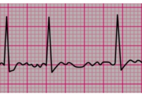 Atrial-Fibrillation_hd_sd.jpg