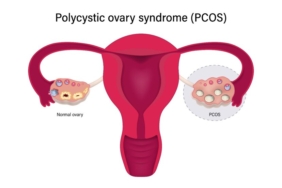 a-diagram-polycystic-ovarian-syndrome-pcos-828x552-1.jpeg