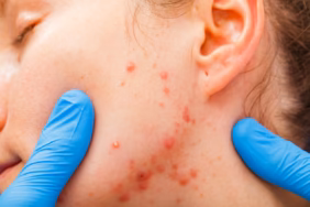 acne-treatments.avif.avif