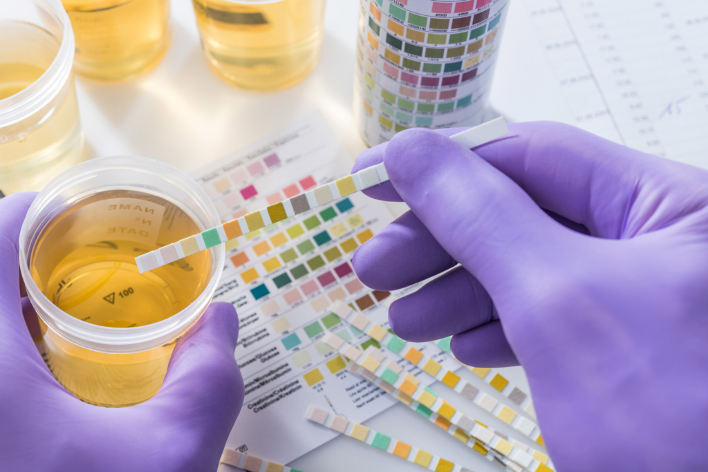 Një analizë urine dhe shumë të dhëna për veshkat e zemrën!